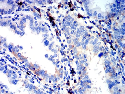 Figure 5:Immunohistochemical analysis of paraffin-embedded endometrial cancer tissues using IGLC2 mouse mAb with DAB staining.