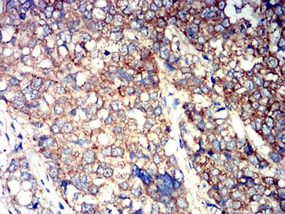 Figure 7:Immunohistochemical analysis of paraffin-embedded breast cancer tissues using ATG3 mouse mAb with DAB staining.