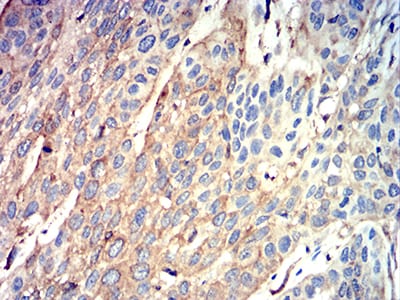 Figure 8:Immunohistochemical analysis of paraffin-embedded esophageal cancer tissues using ATG3 mouse mAb with DAB staining.