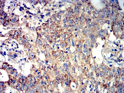 Figure 7:Immunohistochemical analysis of paraffin-embedded stomach cancer tissues using ATG3 mouse mAb with DAB staining.