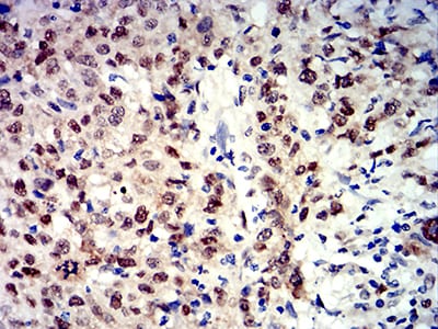 Figure 7:Immunohistochemical analysis of paraffin-embedded breast cancer tissues using APEX1 mouse mAb with DAB staining.