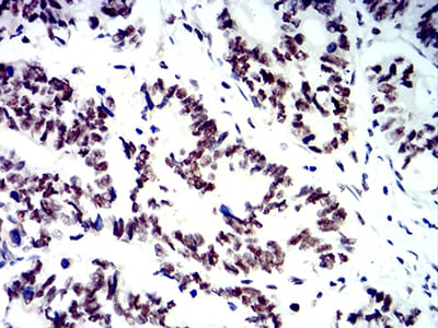 Figure 7:Immunohistochemical analysis of paraffin-embedded rectum cancer tissues using SMARCA1 mouse mAb with DAB staining.