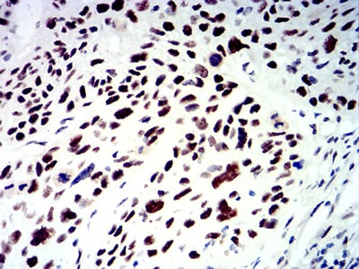 Figure 6:Immunohistochemical analysis of paraffin-embedded esophageal cancer tissues using SMARCA1 mouse mAb with DAB staining.