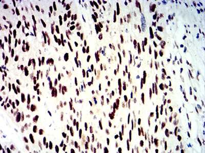 Figure 6:Immunohistochemical analysis of paraffin-embedded esophageal cancer tissues using SMARCA1 mouse mAb with DAB staining.