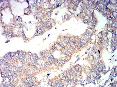 Figure 7:Immunohistochemical analysis of paraffin-embedded stomach cancer tissues using RUNX3 mouse mAb with DAB staining.