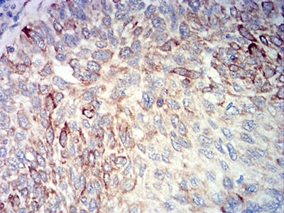 Figure 6:Immunohistochemical analysis of paraffin-embedded lung cancer tissues using BCL2L10 mouse mAb with DAB staining.