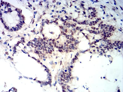 Figure 7:Immunohistochemical analysis of paraffin-embedded colon cancer tissues using BCL11B mouse mAb with DAB staining.