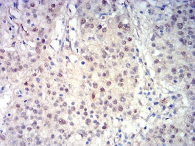 Figure 8:Immunohistochemical analysis of paraffin-embedded stomach cancer tissues using BCL11B mouse mAb with DAB staining.