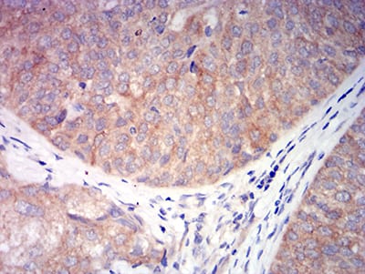 Figure 7:Immunohistochemical analysis of paraffin-embedded bladder cancer tissues using CHRNA6 mouse mAb with DAB staining.