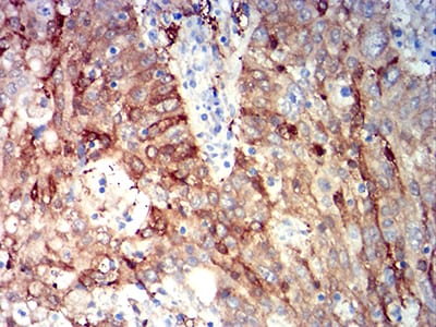 Figure 7:Immunohistochemical analysis of paraffin-embedded stomach cancer tissues using ALDH1A1 mouse mAb with DAB staining.