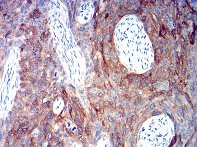 Figure 5:Immunohistochemical analysis of paraffin-embedded cervical cancer tissues using ALDH1A1 mouse mAb with DAB staining.