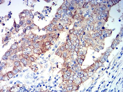 Figure 6:Immunohistochemical analysis of paraffin-embedded stomach cancer tissues using ALDH1A1 mouse mAb with DAB staining.