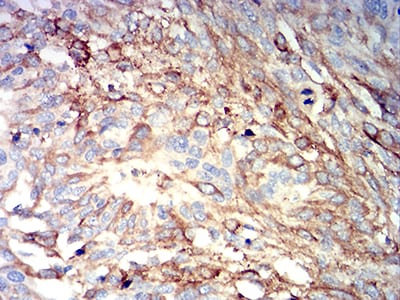 Figure 6:Immunohistochemical analysis of paraffin-embedded esophageal cancer tissues using IGHM mouse mAb with DAB staining.