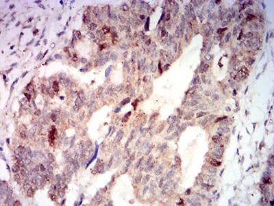 Figure 9:Immunohistochemical analysis of paraffin-embedded rectum cancer tissues using AURKA mouse mAb with DAB staining.