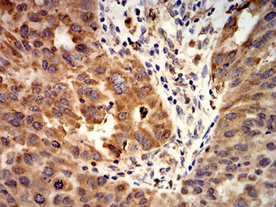 Figure 7:Immunohistochemical analysis of paraffin-embedded ovarian cancer tissues using ACVR1 mouse mAb with DAB staining.