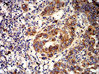 Figure 8:Immunohistochemical analysis of paraffin-embedded endometrial cancer tissues using ACVR1 mouse mAb with DAB staining.