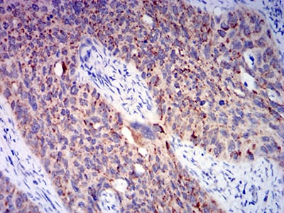 Figure 4:Immunohistochemical analysis of paraffin-embedded cervical cancer tissues using BAX mouse mAb with DAB staining.