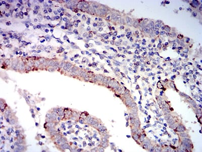 Figure 5:Immunohistochemical analysis of paraffin-embedded endometrial cancer tissues using BAX mouse mAb with DAB staining.