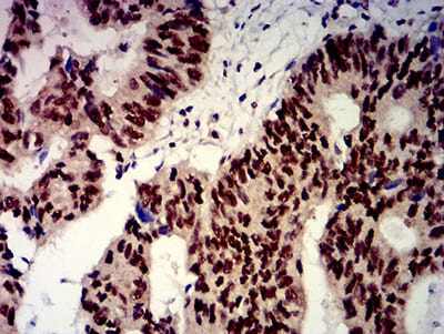 Figure 6:Immunohistochemical analysis of paraffin-embedded esophageal cancer tissues using BTRC mouse mAb with DAB staining.