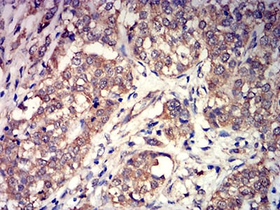 Figure 5:Immunohistochemical analysis of paraffin-embedded bladder cancer tissues using GRM3 mouse mAb with DAB staining.