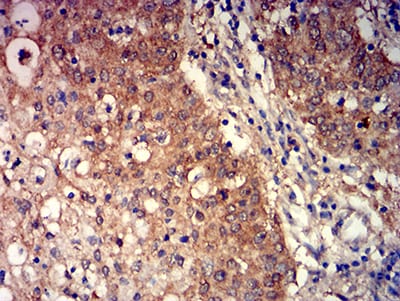 Figure 6:Immunohistochemical analysis of paraffin-embedded stomach cancer tissues using GRM3 mouse mAb with DAB staining.