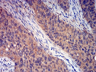 Figure 6:Immunohistochemical analysis of paraffin-embedded cervical cancer tissues using GRM3 mouse mAb with DAB staining.