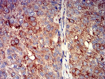 Figure 5:Immunohistochemical analysis of paraffin-embedded bladder cancer tissues using CHRNA7 mouse mAb with DAB staining.