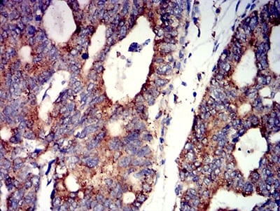 Figure 6:Immunohistochemical analysis of paraffin-embedded rectum cancer tissues using CHRNA7 mouse mAb with DAB staining.