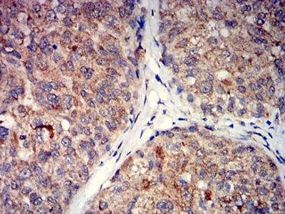 Figure 5:Immunohistochemical analysis of paraffin-embedded bladder cancer tissues using GRM5 mouse mAb with DAB staining.