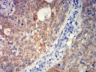 Figure 6:Immunohistochemical analysis of paraffin-embedded stomach cancer tissues using GRM5 mouse mAb with DAB staining.