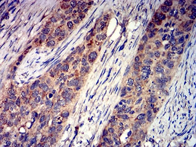 Figure 7:Immunohistochemical analysis of paraffin-embedded cervical cancer tissues using GRIK4 mouse mAb with DAB staining.