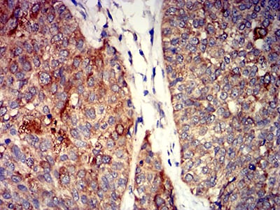 Figure 8:Immunohistochemical analysis of paraffin-embedded bladder cancer tissues using GRIK4 mouse mAb with DAB staining.