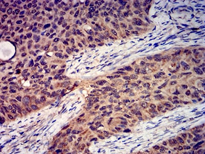 Figure 6:Immunohistochemical analysis of paraffin-embedded cervical cancer tissues using GRIK4 mouse mAb with DAB staining.