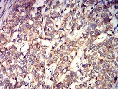 Figure 7:Immunohistochemical analysis of paraffin-embedded bladder cancer tissues using GRIK4 mouse mAb with DAB staining.