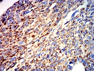 Figure 6:Immunohistochemical analysis of paraffin-embedded lung cancer tissues using ATPIF1 mouse mAb with DAB staining.