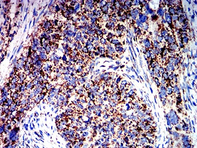 Figure 7:Immunohistochemical analysis of paraffin-embedded cervical cancer tissues using ATPIF1 mouse mAb with DAB staining.