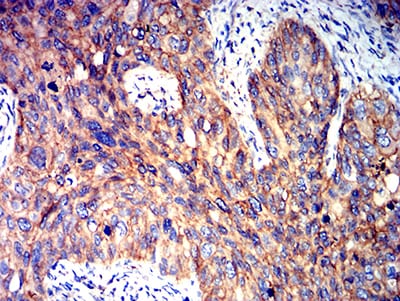 Figure 6:Immunohistochemical analysis of paraffin-embedded cervical cancer tissues using PRKAB2 mouse mAb with DAB staining.