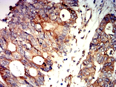 Figure 7:Immunohistochemical analysis of paraffin-embedded rectum cancer tissues using PRKAB2 mouse mAb with DAB staining.