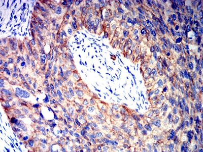 Figure 6:Immunohistochemical analysis of paraffin-embedded cervical cancer tissues using CTNNB1 mouse mAb with DAB staining.