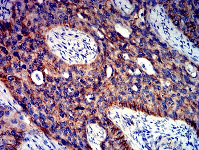 Figure 6:Immunohistochemical analysis of paraffin-embedded cervical cancer tissues using CTNNB1 mouse mAb with DAB staining.