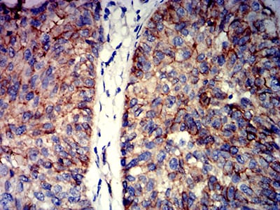 Figure 7:Immunohistochemical analysis of paraffin-embedded bladder cancer tissues using CTNNB1 mouse mAb with DAB staining.