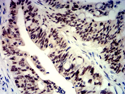 Figure 5:Immunohistochemical analysis of paraffin-embedded rectum cancer tissues using BTRC mouse mAb with DAB staining.