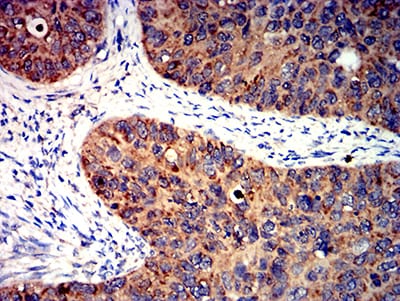 Figure 8:Immunohistochemical analysis of paraffin-embedded cervical cancer tissues using BCL2L2 mouse mAb with DAB staining.