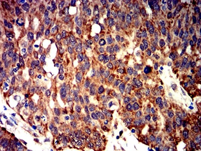 Figure 9:Immunohistochemical analysis of paraffin-embedded ovarian cancer tissues using BCL2L2 mouse mAb with DAB staining.