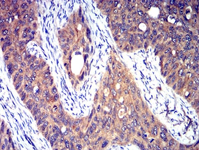 Figure 6:Immunohistochemical analysis of paraffin-embedded cervical cancer tissues using HTR3A mouse mAb with DAB staining.