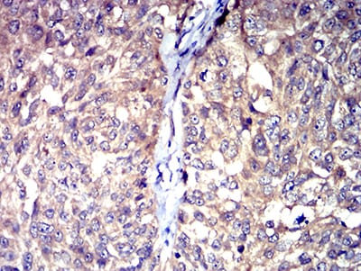 Figure 7:Immunohistochemical analysis of paraffin-embedded bladder cancer tissues using HTR3A mouse mAb with DAB staining.
