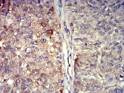 Figure 7:Immunohistochemical analysis of paraffin-embedded bladder cancer tissues using TNFSF11 mouse mAb with DAB staining.