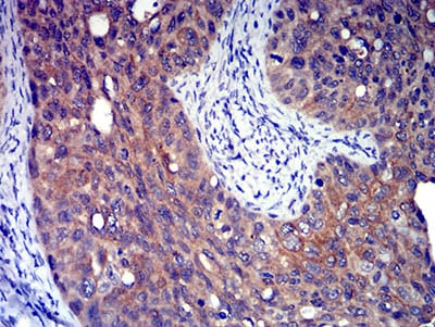 Figure 6:Immunohistochemical analysis of paraffin-embedded cervical cancer tissues using P2RY8 mouse mAb with DAB staining.