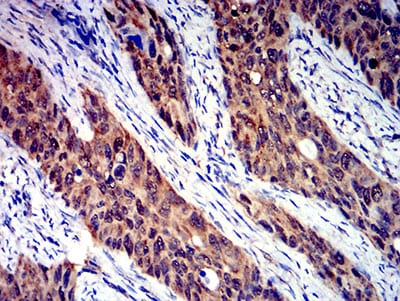 Figure 6:Immunohistochemical analysis of paraffin-embedded cervical cancer tissues using CD100 mouse mAb with DAB staining.