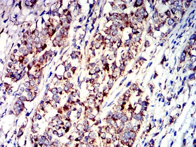 Figure 7:Immunohistochemical analysis of paraffin-embedded bladder cancer tissues using P2RY1 mouse mAb with DAB staining.